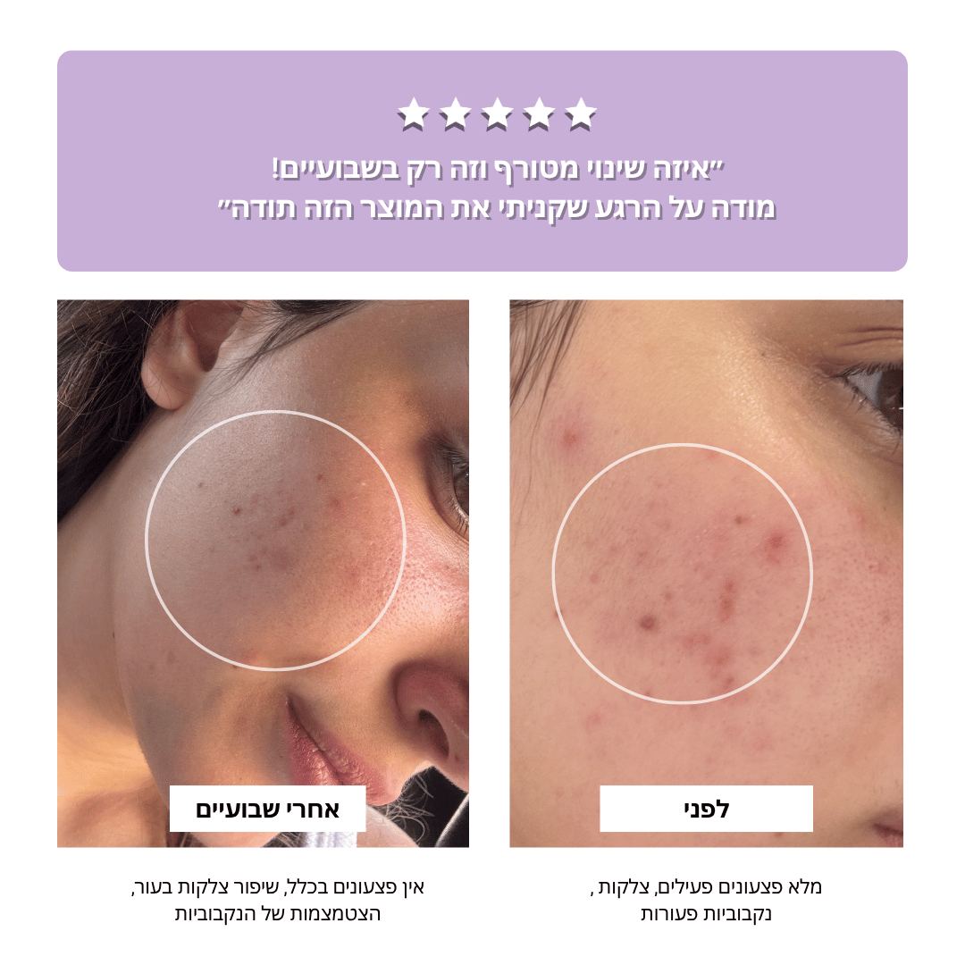 מכשיר תדר גבוה | מונע ומטפל בפצעונים וצלקות פוסט אקנה